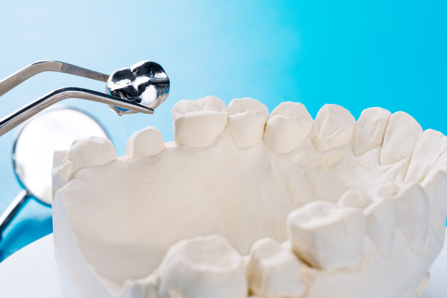 Porcelain Crowns