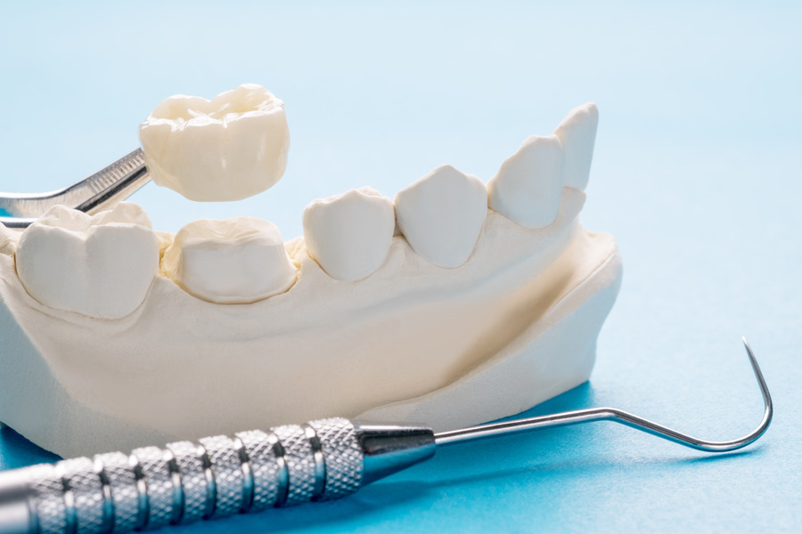 Porcelain Crowns