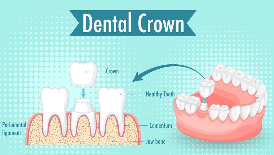 Porcelain Crowns
