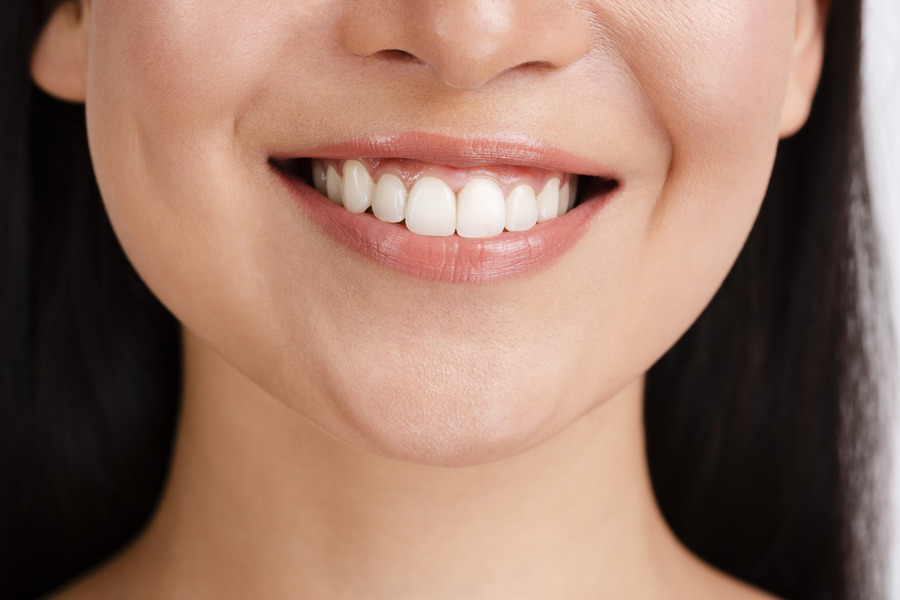Smile Makeover